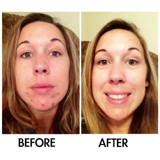 Derm #1 Two-Step All-Natural Acne Regimen with Blemish Corrector
