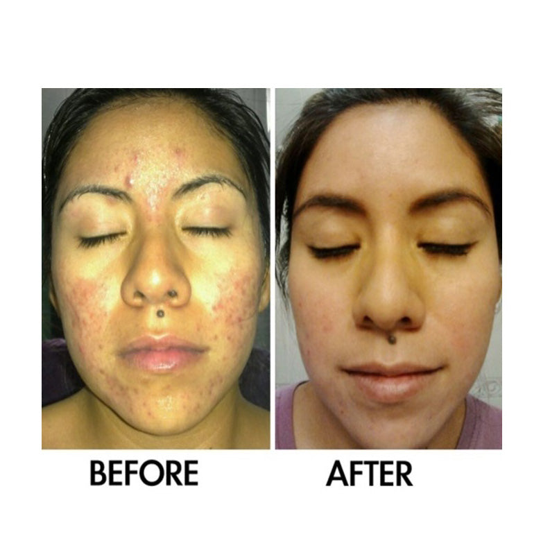 Derm #1 Two-Step All-Natural Acne Regimen with Blemish Corrector
