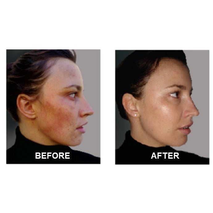 Derm #1 Two-Step All-Natural Acne Regimen with Blemish Corrector